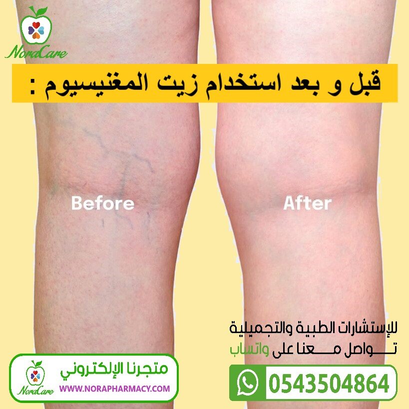 بخاخ المغنيسيوم للشد العضلي Magnesium Oil - الصورة 2