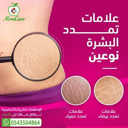 ⁦ميبو سكار للجروح و الاثار Mebo Scar Ointment⁩ - الصورة ⁦5⁩
