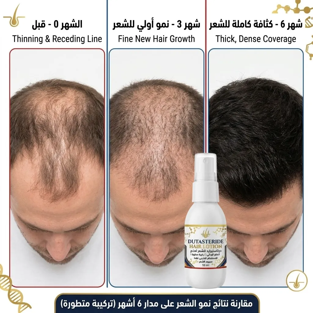 دوتاستيرايد للشعر لعلاج الصلع الوراثي DUTASTERIDE HAIR - الصورة 2