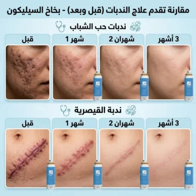 سيليكون جل علاج الندبات كيلوكوت بخاخ KELO COTE